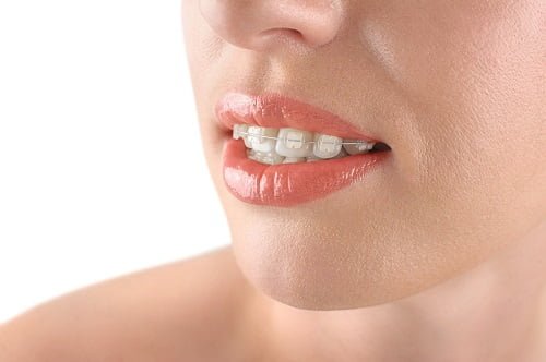 The Benefits of Choosing Braces for Dental Alignment and Oral Health Improvement in Las Vegas